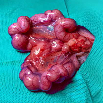 Surgically removed enlarged uterus on a green surgical drape